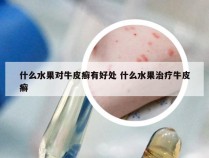 什么水果对牛皮癣有好处 什么水果治疗牛皮癣