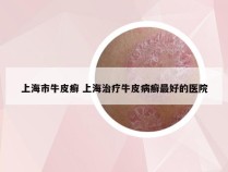 上海市牛皮癣 上海治疗牛皮病癣最好的医院