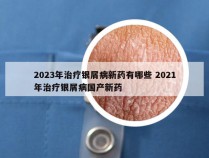 2023年治疗银屑病新药有哪些 2021年治疗银屑病国产新药