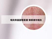 咽炎和面部银屑病 银屑病与咽炎