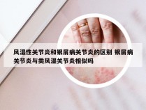 风湿性关节炎和银屑病关节炎的区别 银屑病关节炎与类风湿关节炎相似吗