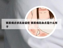 银屑病点状出血留疤 银屑病出血点是什么样子