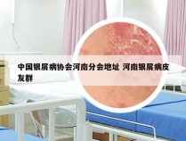中国银屑病协会河南分会地址 河南银屑病皮友群