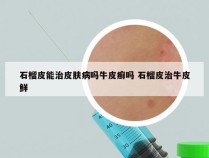 石榴皮能治皮肤病吗牛皮癣吗 石榴皮治牛皮鲜