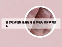 扑尔敏减轻银屑病贴吧 扑尔敏对银屑病有用吗