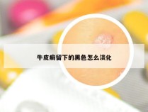 牛皮癣留下的黑色怎么淡化