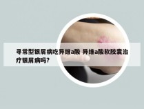 寻常型银屑病吃异维a酸 异维a酸软胶囊治疗银屑病吗?