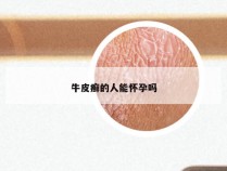 牛皮癣的人能怀孕吗