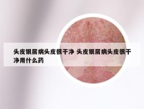 头皮银屑病头皮很干净 头皮银屑病头皮很干净用什么药