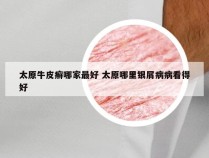 太原牛皮癣哪家最好 太原哪里银屑病病看得好