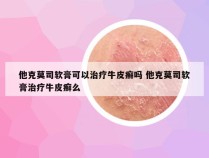 他克莫司软膏可以治疗牛皮癣吗 他克莫司软膏治疗牛皮癣么