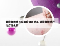 甘露聚糖肽可以治疗银屑病么 甘露聚糖肽片治疗什么的
