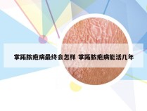 掌跖脓疱病最终会怎样 掌跖脓疱病能活几年