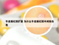 牛皮癣红斑扩散 为什么牛皮癣红斑中间有白色