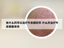 有什么药可以治疗牛皮癣好药 什么药治疗牛皮癣最有效