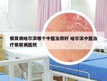 银屑病哈尔滨哪个中医治得好 哈尔滨中医治疗银屑病医院