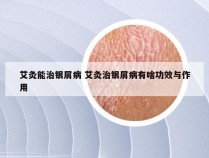 艾灸能治银屑病 艾灸治银屑病有啥功效与作用