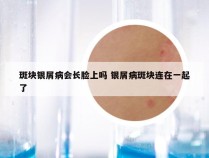 斑块银屑病会长脸上吗 银屑病斑块连在一起了