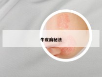牛皮癣秘法