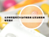 北京哪家医院打针治疗银屑病 北京治银屑病哪家最好