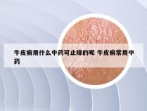 牛皮癣用什么中药可止痒的呢 牛皮癣常用中药