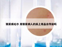 银屑病毛巾 用银屑病人的床上用品会传染吗