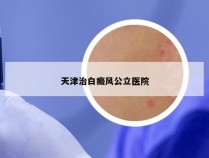 天津治白癜风公立医院