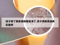 孩子得了银屑病我要崩溃了 孩子得银屑病真实案例