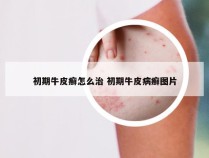 初期牛皮癣怎么治 初期牛皮病癣图片