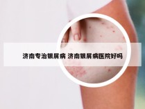 济南专治银屑病 济南银屑病医院好吗