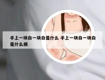 手上一块白一块白是什么 手上一块白一块白是什么病