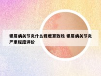银屑病关节炎什么程度算致残 银屑病关节炎严重程度评价