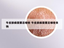 牛皮肤癣需要忌哪些 牛皮肤癣需要忌哪些食物