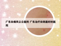 广东白癜风公立医院 广东治疗白斑最好的医院