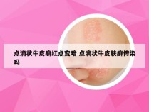 点滴状牛皮癣红点变暗 点滴状牛皮肤癣传染吗