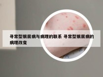 寻常型银屑病与病理的联系 寻常型银屑病的病理改变