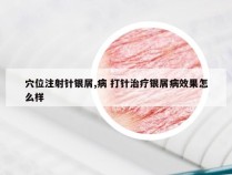穴位注射针银屑,病 打针治疗银屑病效果怎么样