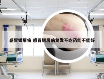 感冒银屑病 感冒银屑病复发不吃药能不能好