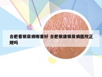 合肥看银屑病哪里好 合肥银康银屑病医院正规吗