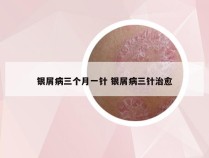 银屑病三个月一针 银屑病三针治愈