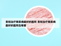 贵阳治疗银屑病最好的医院 贵阳治疗银屑病最好的医院在哪里
