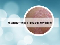 牛皮癣长什么样子 牛皮皮癣怎么造成的