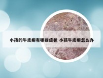 小孩的牛皮癣有哪些症状 小孩牛皮癣怎么办