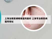 上海治银屑病哪里医院最好 上海专治银屑病医院地址