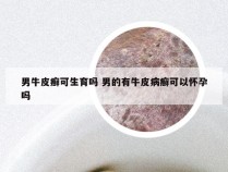 男牛皮癣可生育吗 男的有牛皮病癣可以怀孕吗