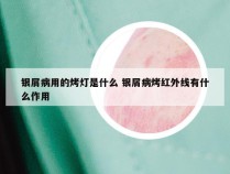 银屑病用的烤灯是什么 银屑病烤红外线有什么作用