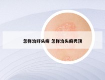 怎样治好头癣 怎样治头癣秃顶