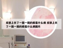 皮肤上长了一圈一圈的癣是什么病 皮肤上长了一圈一圈的癣是什么病图片