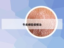 牛皮癣轻症根治