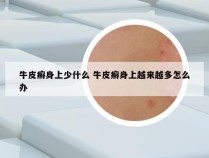 牛皮癣身上少什么 牛皮癣身上越来越多怎么办